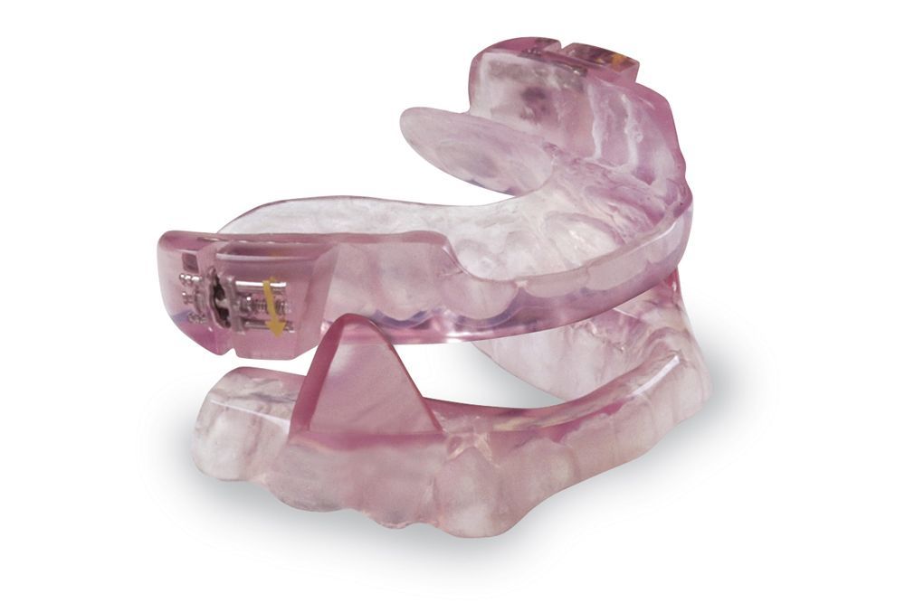 An example of a mouth guard to be worn at night 