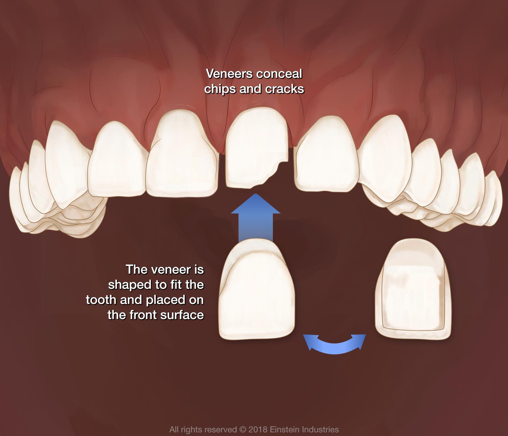 Veneers illustration